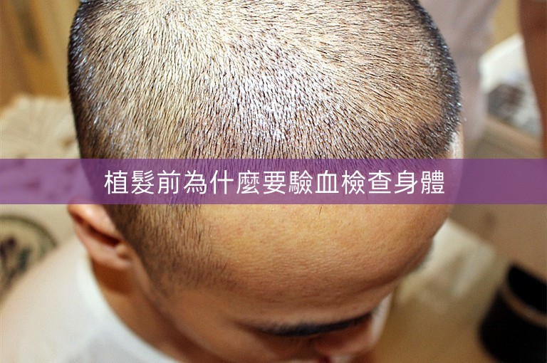 植髮前為什麼要驗血檢查身體