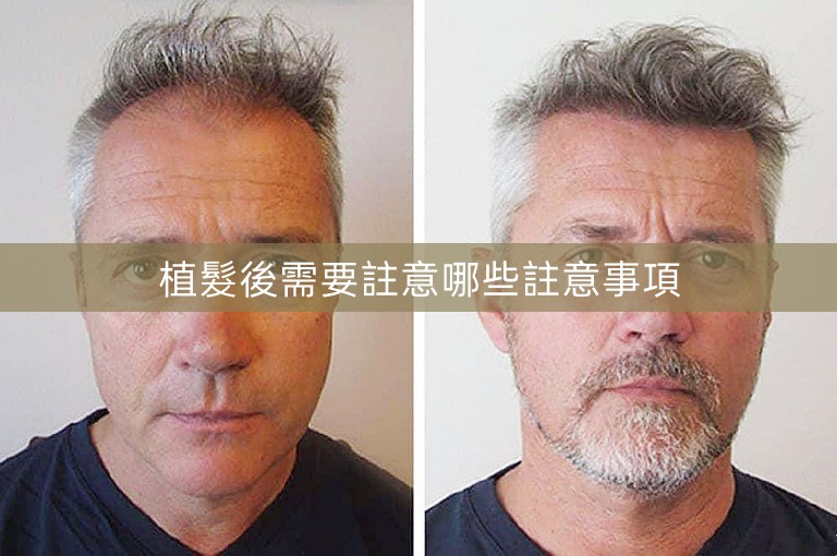 植髮後需要註意哪些註意事項