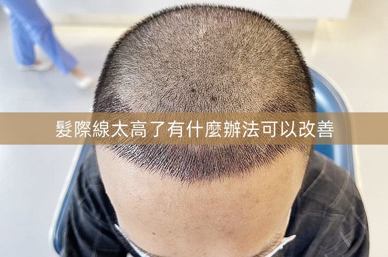 髮際線太高了有什麼辦法可以改善