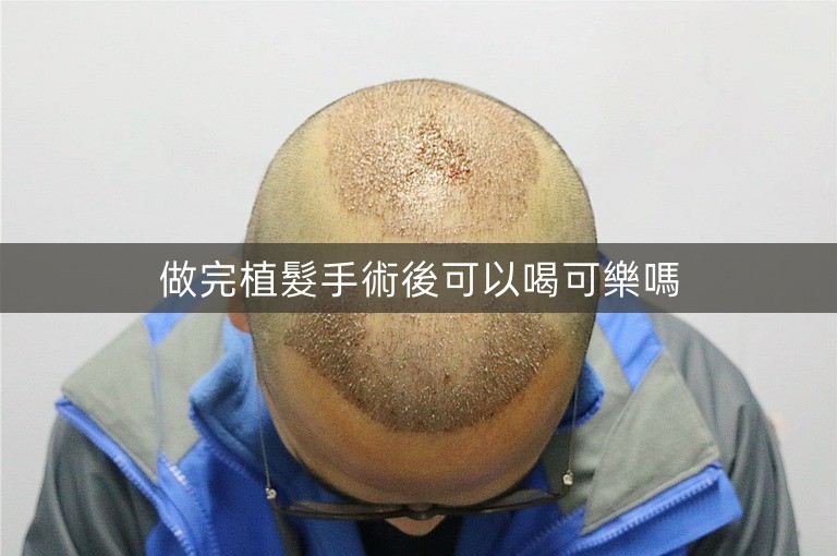 做完植髮手術後可以喝可樂嗎