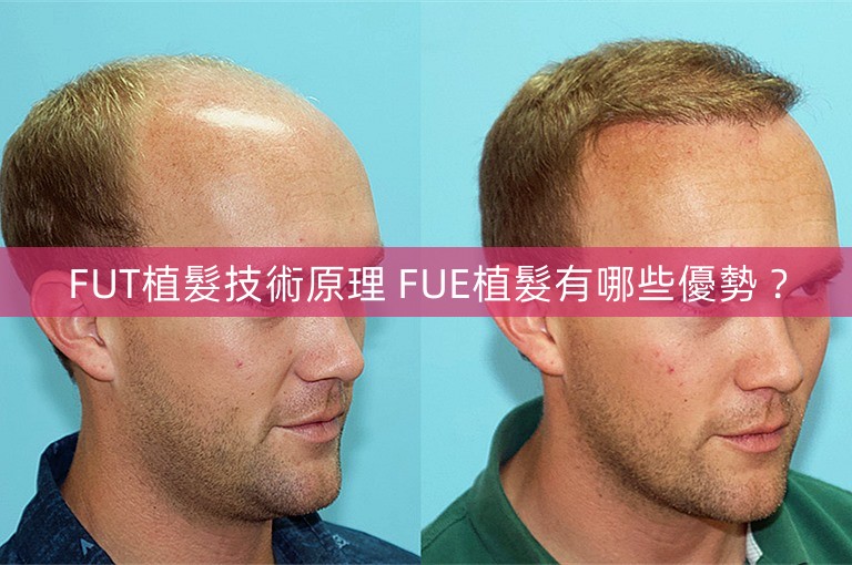 FUT植髮技術原理 FUE植髮有哪些優勢? FUT植髮技術原理 FUE植髮有哪些優勢?