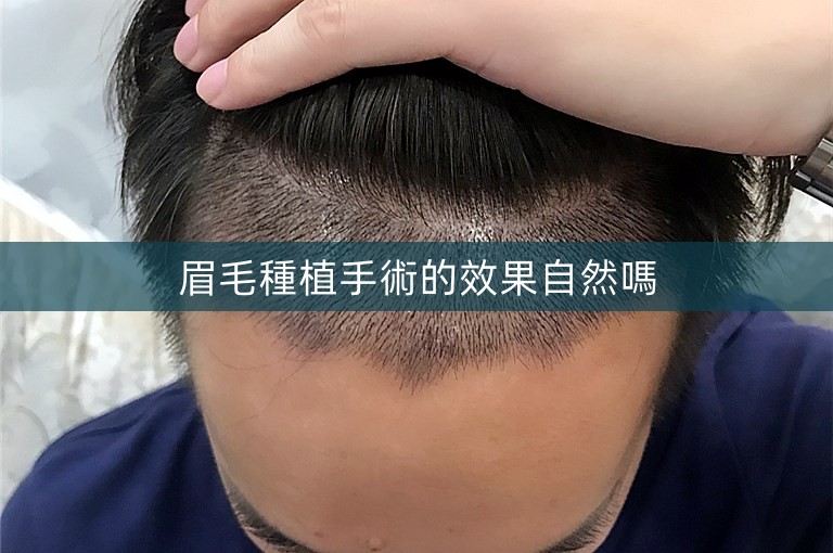 眉毛種植手術的效果自然嗎