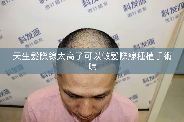 天生髮際線太高了可以做髮際線種植手術嗎 天生髮際線太高了可以做髮際線種植手術嗎