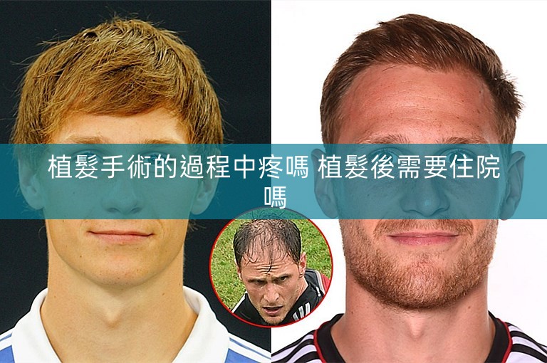 植髮手術的過程中疼嗎 植髮後需要住院嗎
