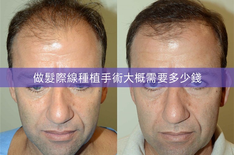做髮際線種植手術大概需要多少錢