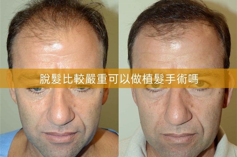 脫髮比較嚴重可以做植髮手術嗎