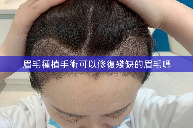 眉毛種植手術可以修復殘缺的眉毛嗎