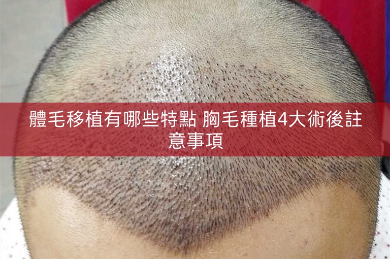 體毛移植有哪些特點 胸毛種植4大術後註意事項