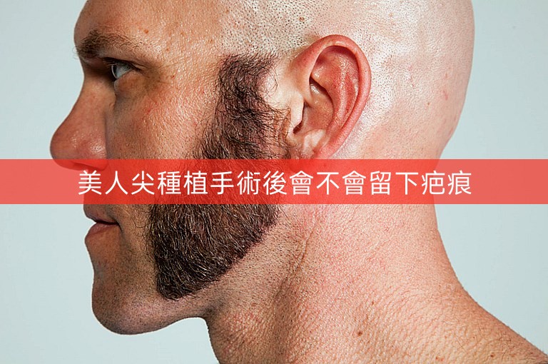美人尖種植手術後會不會留下疤痕