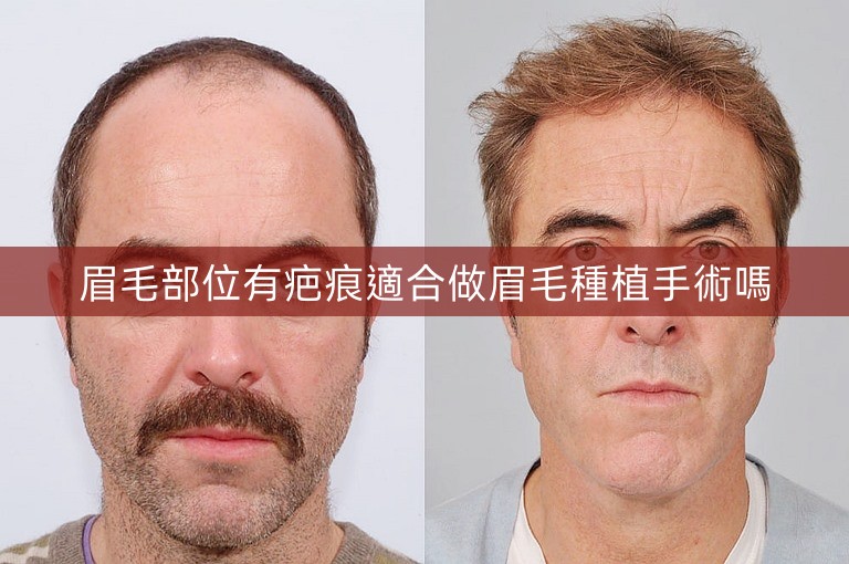 眉毛部位有疤痕適合做眉毛種植手術嗎