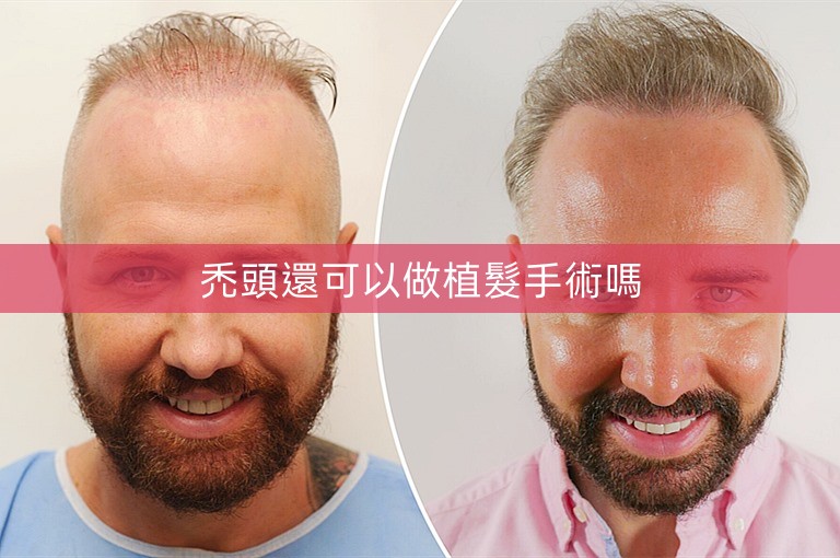禿頭還可以做植髮手術嗎