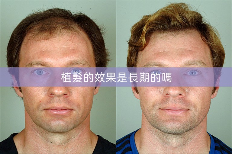 植髮的效果是長期的嗎