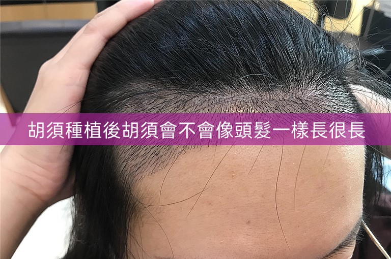 胡須種植後胡須會不會像頭髮一樣長很長