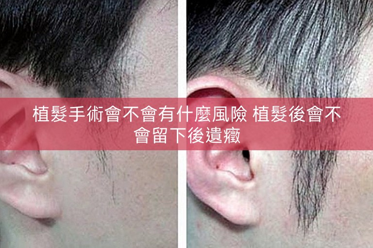 植髮手術會不會有什麼風險 植髮後會不會留下後遺癥