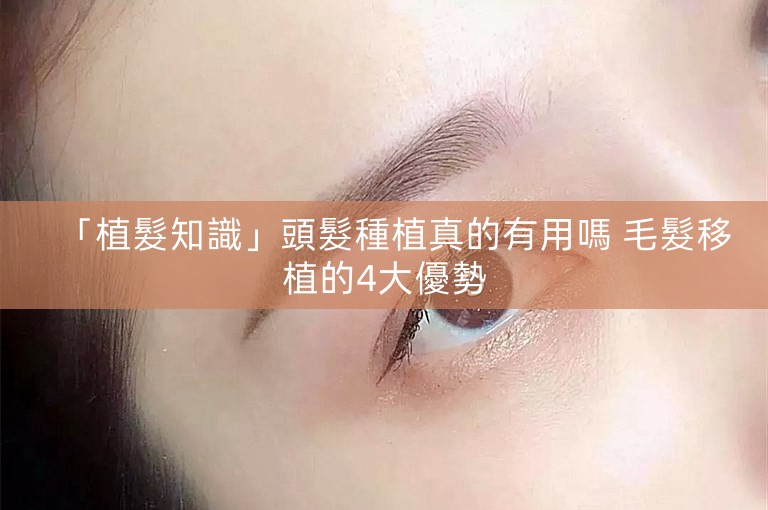 「植髮知識」頭髮種植真的有用嗎 毛髮移植的4大優勢