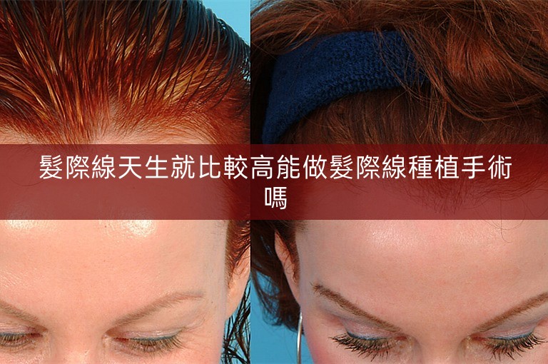 髮際線天生就比較高能做髮際線種植手術嗎