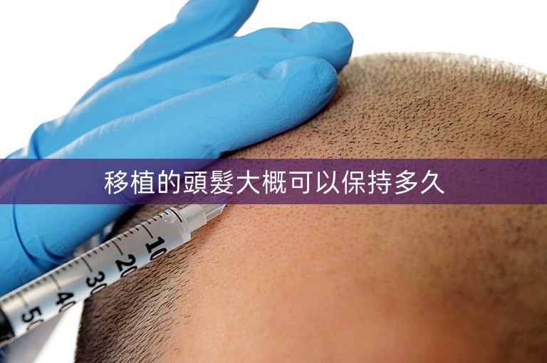 移植的頭髮大概可以保持多久