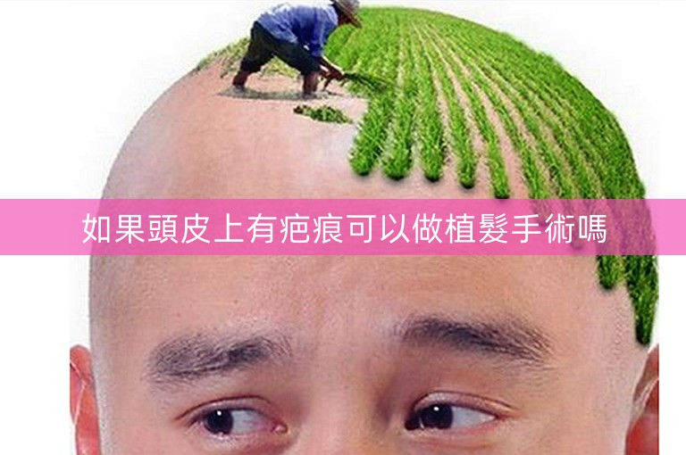 如果頭皮上有疤痕可以做植髮手術嗎