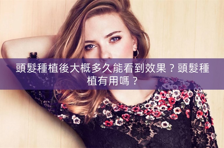 頭髮種植後大概多久能看到效果？頭髮種植有用嗎？