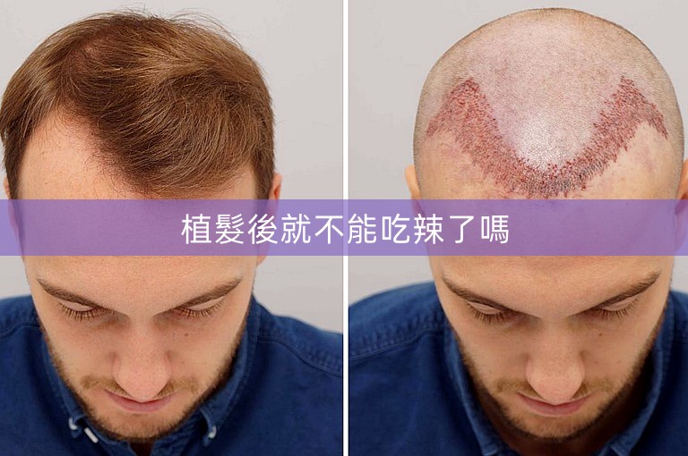 植髮後就不能吃辣了嗎