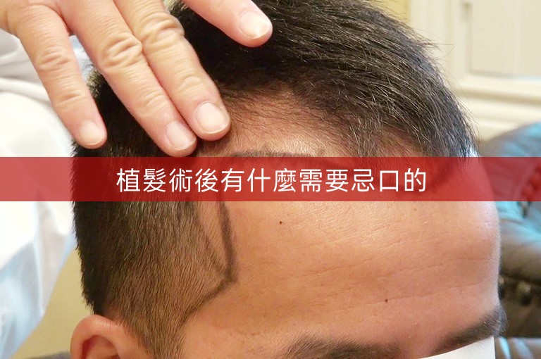 植髮術後有什麼需要忌口的