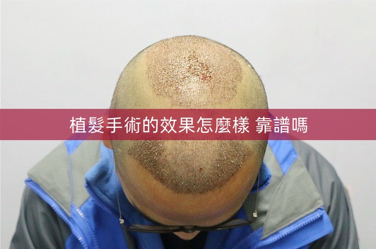 植髮手術的效果怎麼樣 靠譜嗎