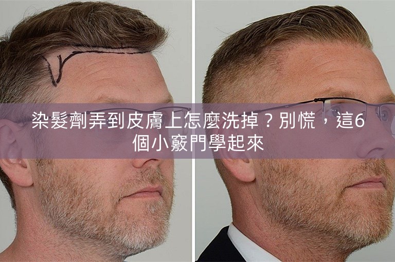 染髮劑弄到皮膚上怎麼洗掉？別慌，這6個小竅門學起來