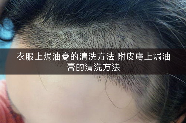 衣服上焗油膏的清洗方法 附皮膚上焗油膏的清洗方法