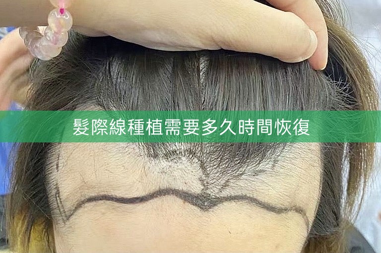 髮際線種植需要多久時間恢復