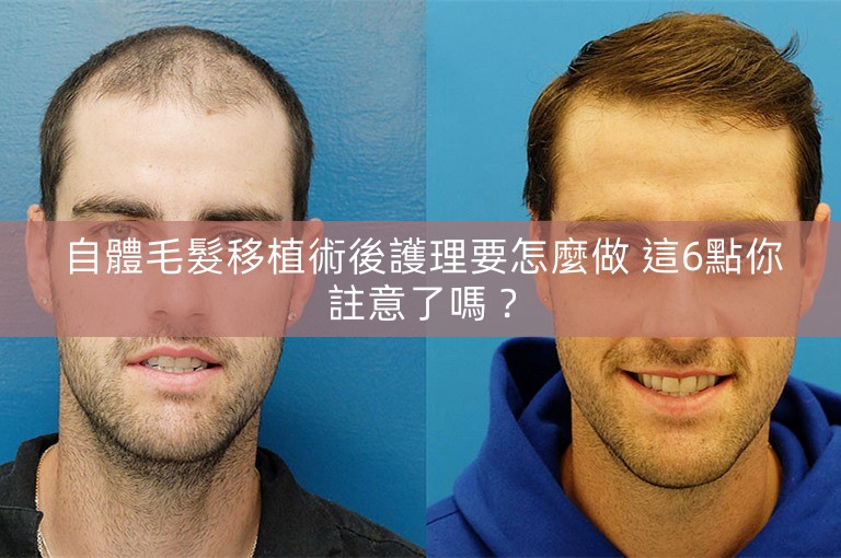 自體毛髮移植術後護理要怎麼做 這6點你註意了嗎? 自體毛髮移植術後護理要怎麼做 這6點你註意了嗎?