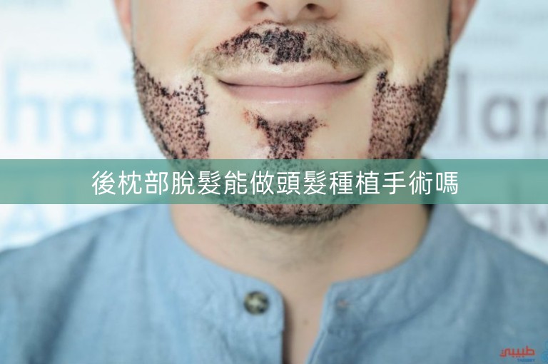 後枕部脫髮能做頭髮種植手術嗎