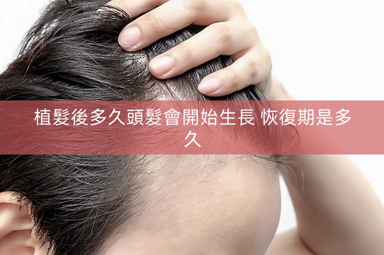 植髮後多久頭髮會開始生長 恢復期是多久