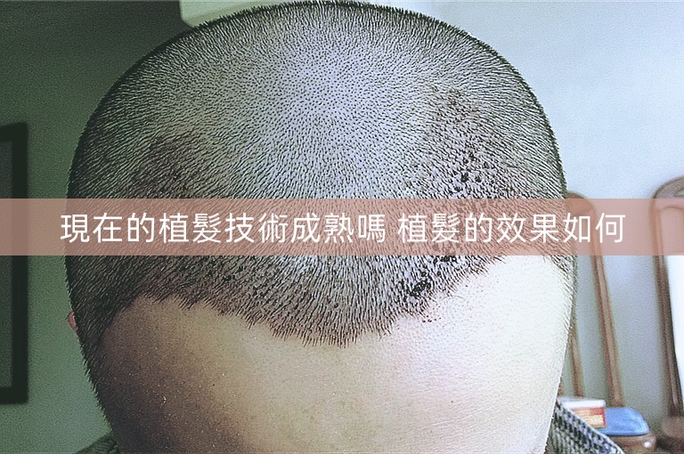 現在的植髮技術成熟嗎 植髮的效果如何