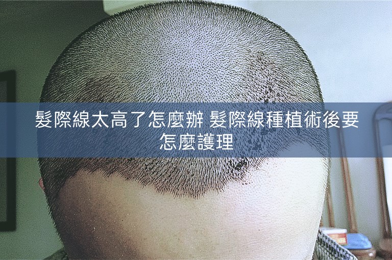 髮際線太高了怎麼辦 髮際線種植術後要怎麼護理