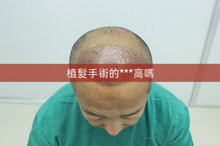 植髮手術的***高嗎