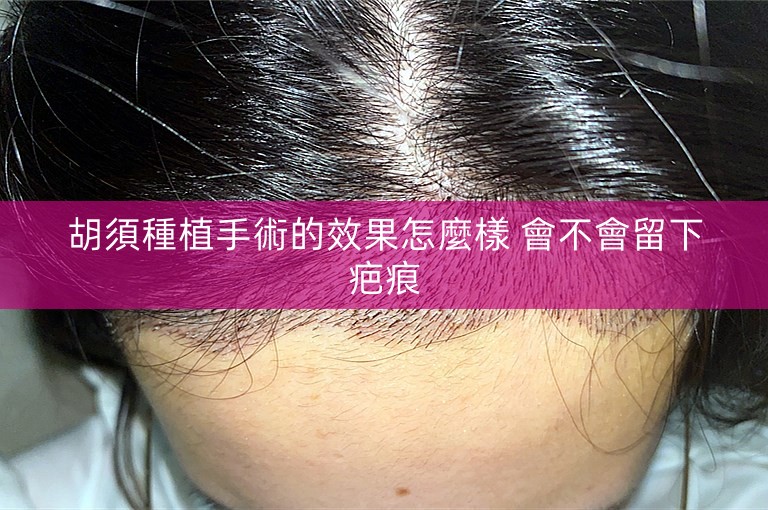 胡須種植手術的效果怎麼樣 會不會留下疤痕