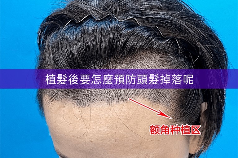 植髮後要怎麼預防頭髮掉落呢