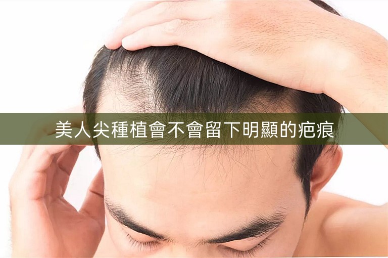 美人尖種植會不會留下明顯的疤痕