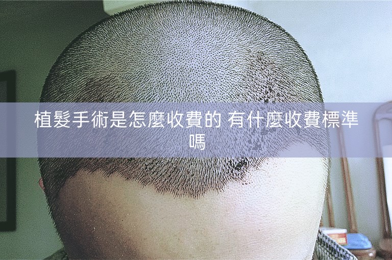 植髮手術是怎麼收費的 有什麼收費標準嗎
