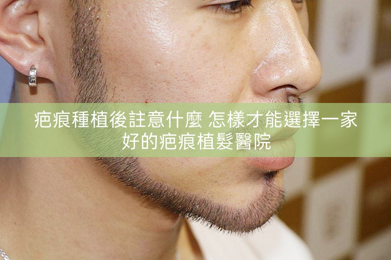 疤痕種植後註意什麼 怎樣才能選擇一家好的疤痕植髮醫院