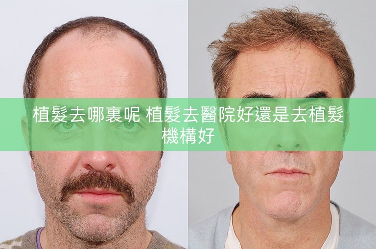 植髮去哪裏呢 植髮去醫院好還是去植髮機構好