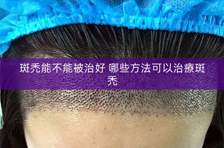 斑禿能不能被治好 哪些方法可以治療斑禿