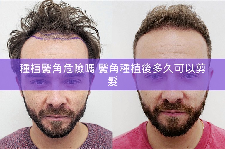種植鬢角危險嗎 鬢角種植後多久可以剪髮