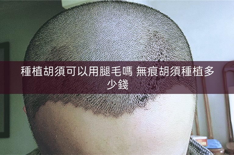 種植胡須可以用腿毛嗎 無痕胡須種植多少錢