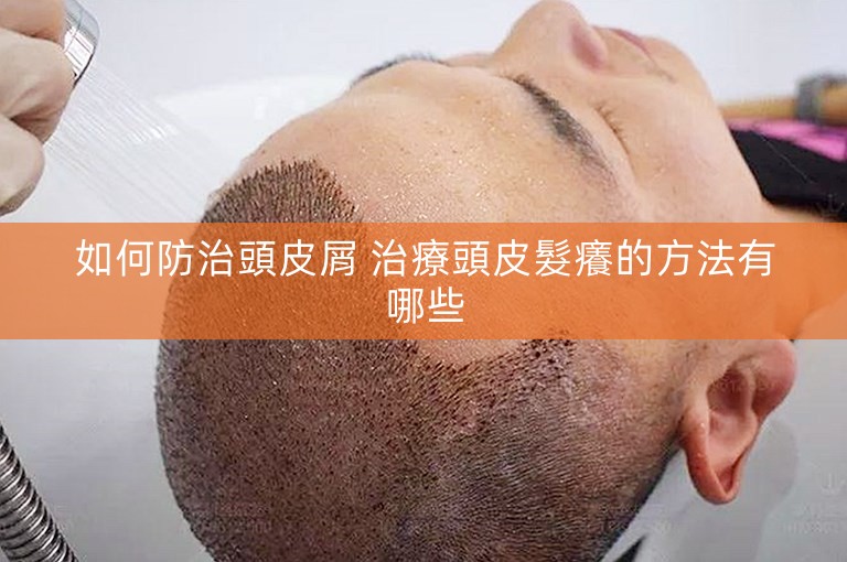 如何防治頭皮屑 治療頭皮髮癢的方法有哪些