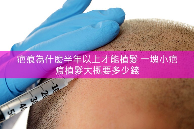 疤痕為什麼半年以上才能植髮 一塊小疤痕植髮大概要多少錢