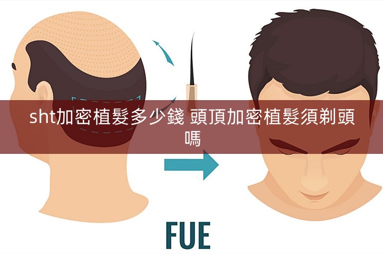sht加密植髮多少錢 頭頂加密植髮須剃頭嗎