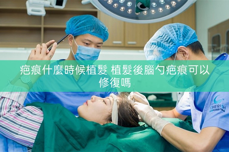 疤痕什麼時候植髮 植髮後腦勺疤痕可以修復嗎