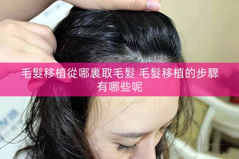 毛髮移植從哪裏取毛髮 毛髮移植的步驟有哪些呢