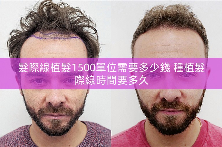 髮際線植髮1500單位需要多少錢 種植髮際線時間要多久